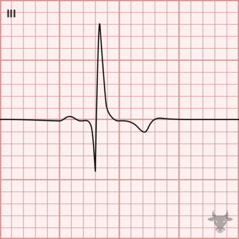 Pulmonary Embolism | ECG Stampede