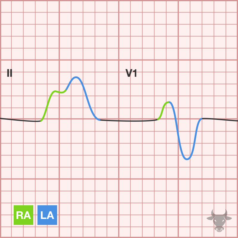 Right Atrial Enlargement ECG Stampede