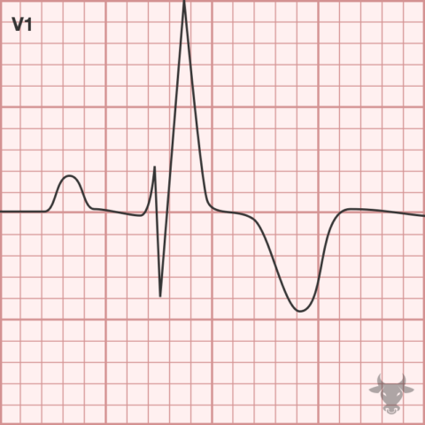 Right Bundle Branch Block | ECG Stampede