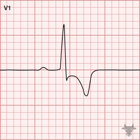 Right Heart Strain | ECG Stampede