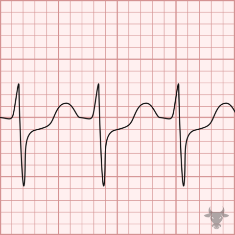 Atrioventricular Reentrant Tachycardia | ECG Stampede