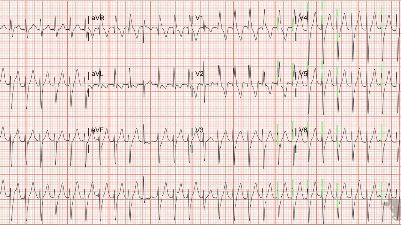 Ventricular Tachycardia | ECG Stampede