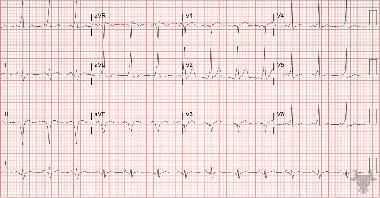 Ventricular Pre-excitation | ECG Stampede