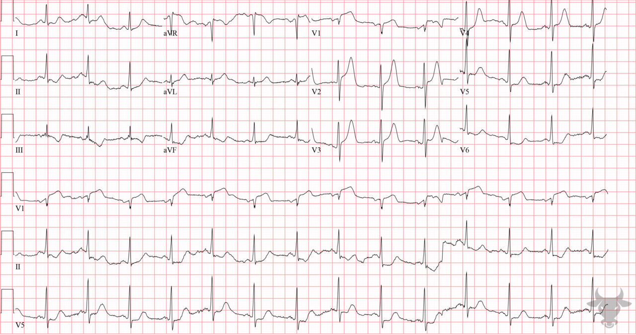 Hyperacute T Waves | ECG Stampede