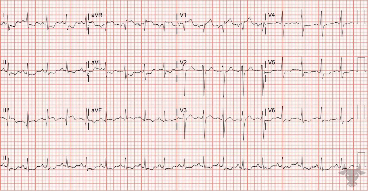 ST-elevation Myocardial Infarction | ECG Stampede