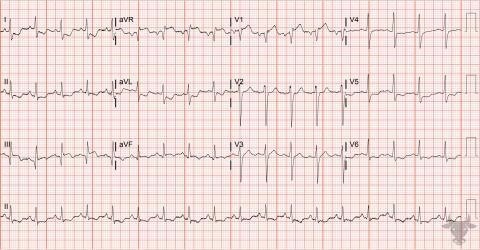 ST-elevation Myocardial Infarction | ECG Stampede