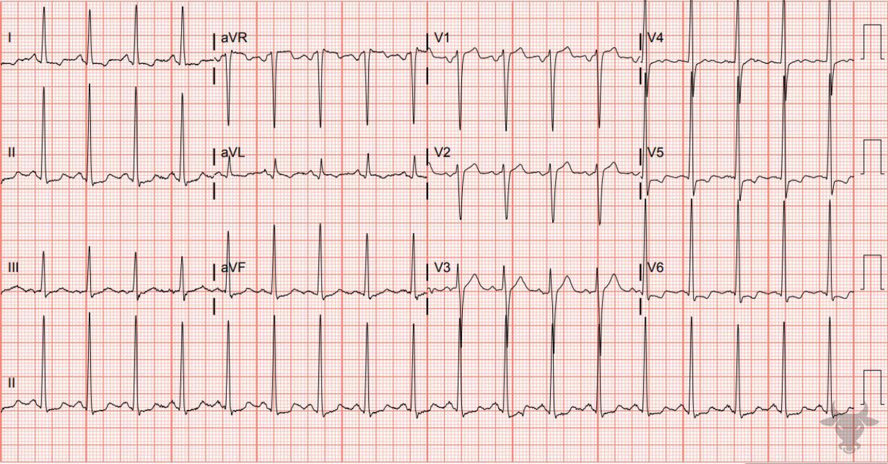 Left Ventricular Hypertrophy | ECG Stampede