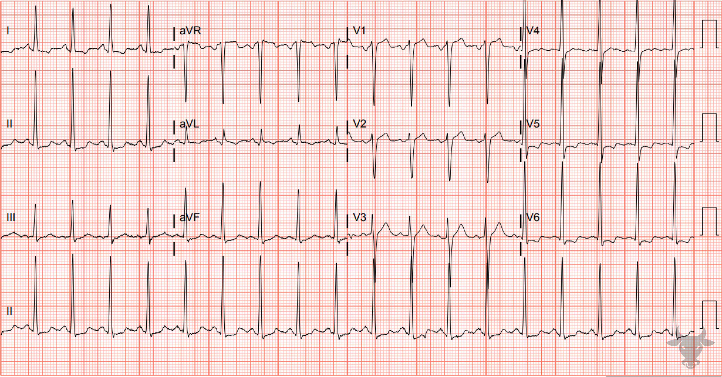 Left Ventricular Hypertrophy ECG Stampede