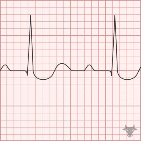 Digoxin Toxicity | ECG Stampede