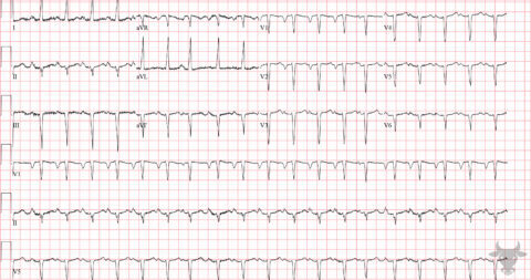 Left Ventricular Hypertrophy | ECG Stampede