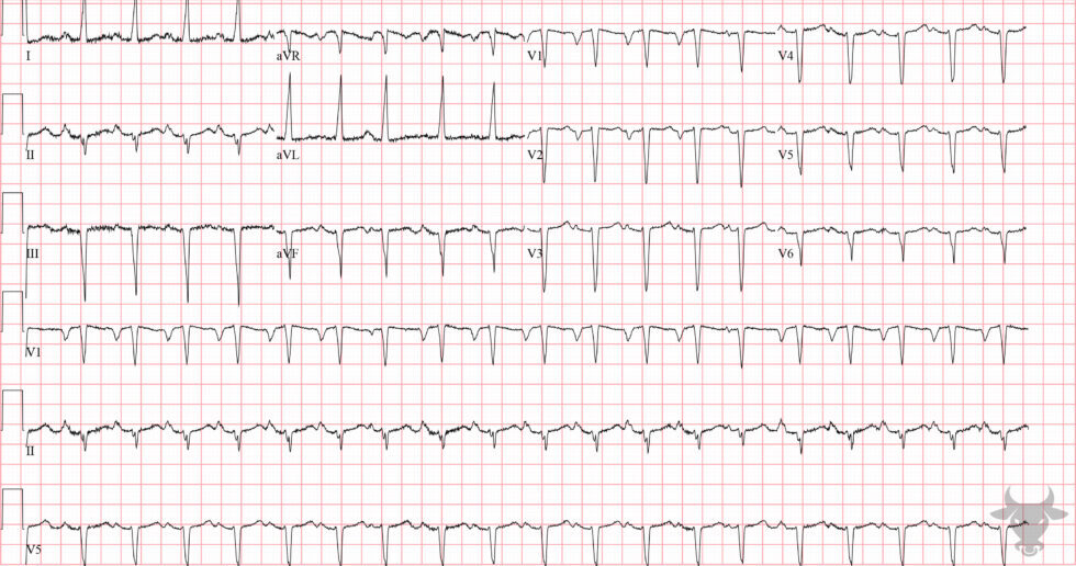 Left Atrial Enlargement Ecg Stampede