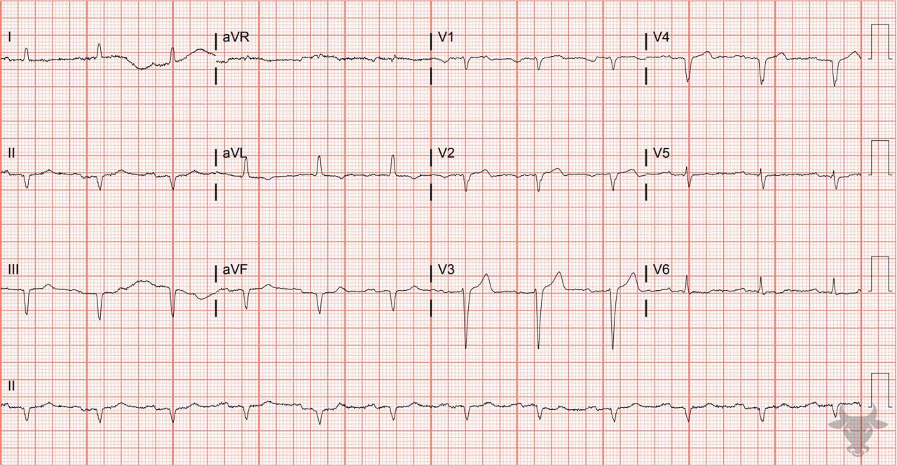 Poor R-wave Progression | ECG Stampede