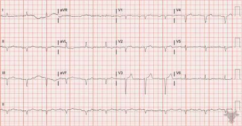 Poor R-wave Progression | ECG Stampede