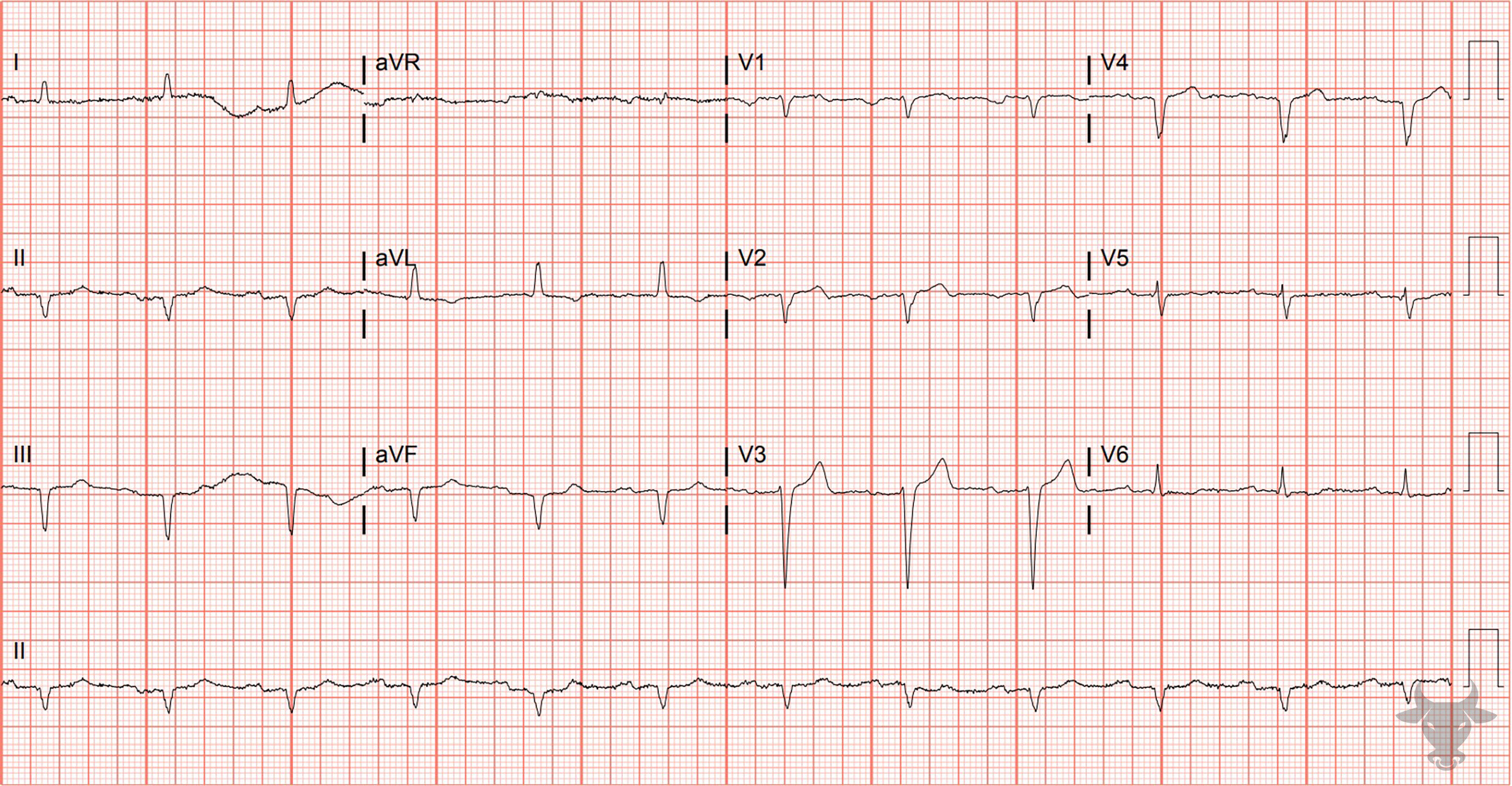 Poor R wave Progression ECG Stampede