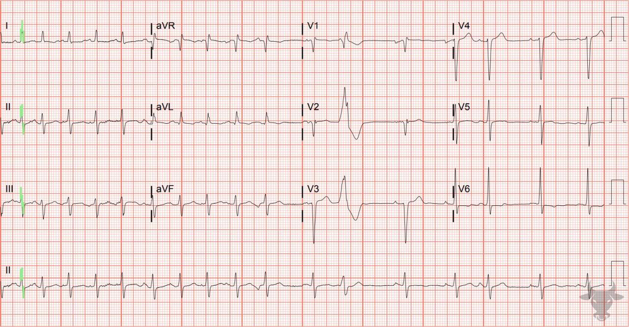 Multifocal Atrial Tachycardia | ECG Stampede