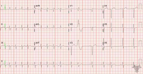 Multifocal Atrial Tachycardia | ECG Stampede