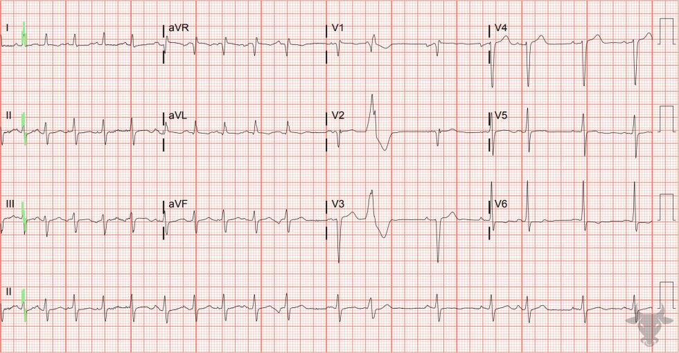 Multifocal Atrial Tachycardia | ECG Stampede