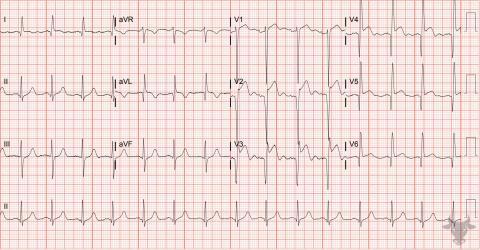 Left Ventricular Aneurysm | ECG Stampede