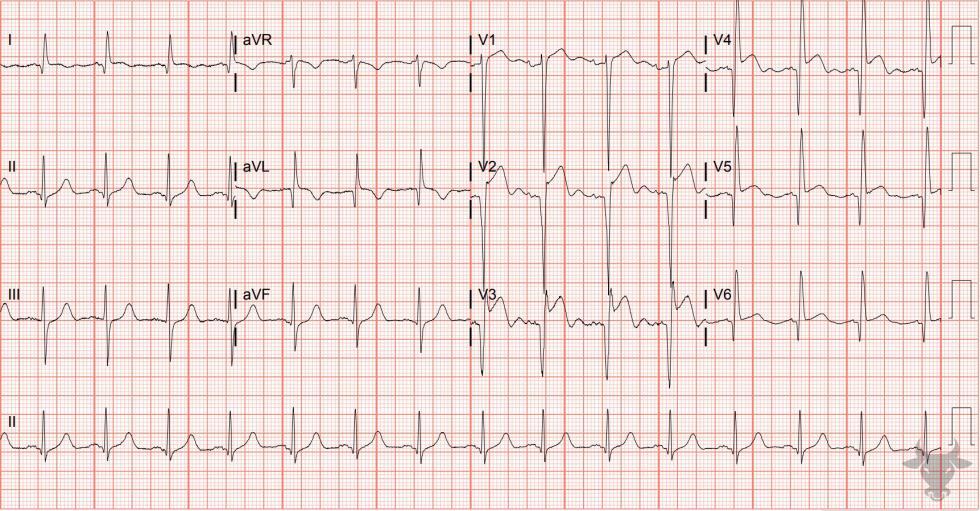 Left Ventricular Aneurysm | ECG Stampede