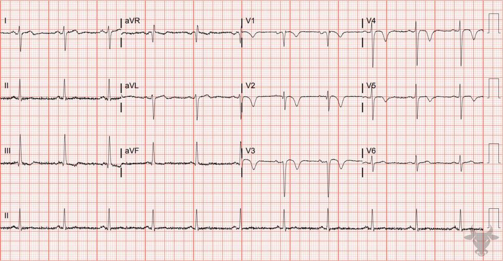 Wellens Syndrome | ECG Stampede