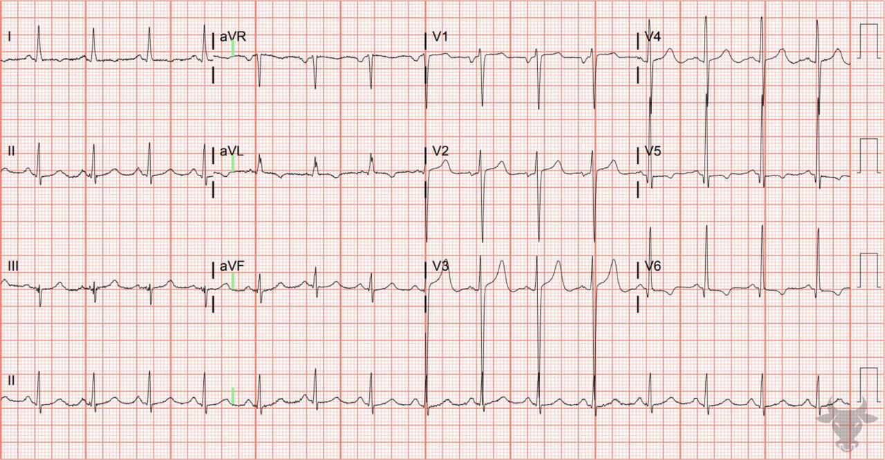 Left Atrial Enlargement | ECG Stampede