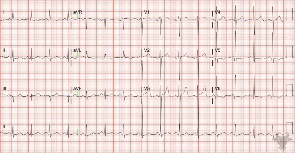 Left Atrial Enlargement | ECG Stampede