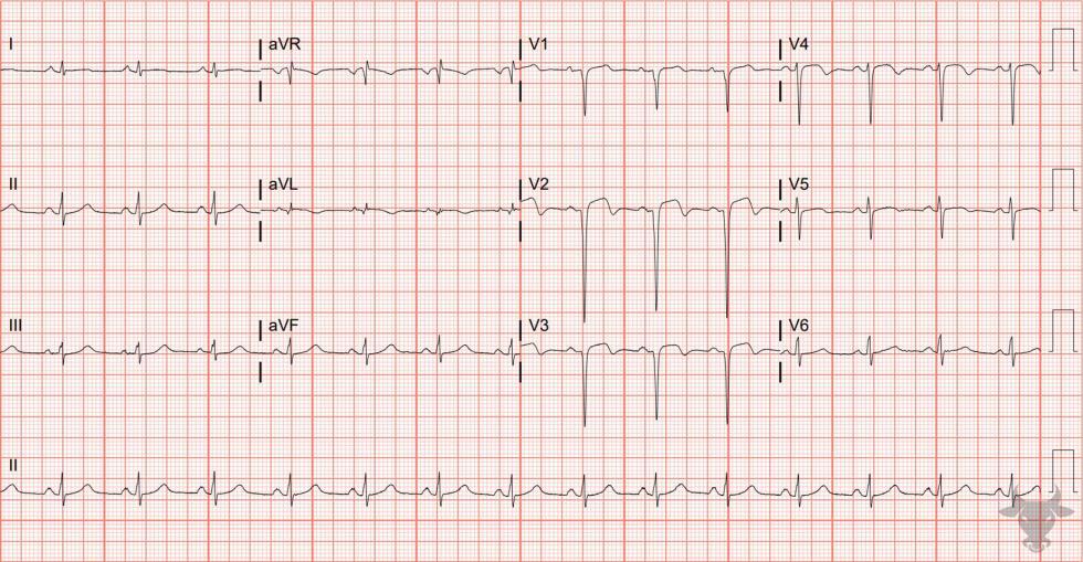 Poor R-wave Progression | ECG Stampede