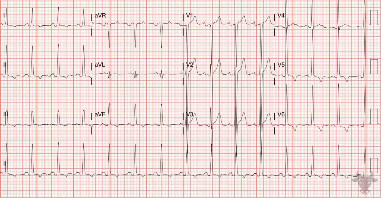 Left Atrial Enlargement | ECG Stampede