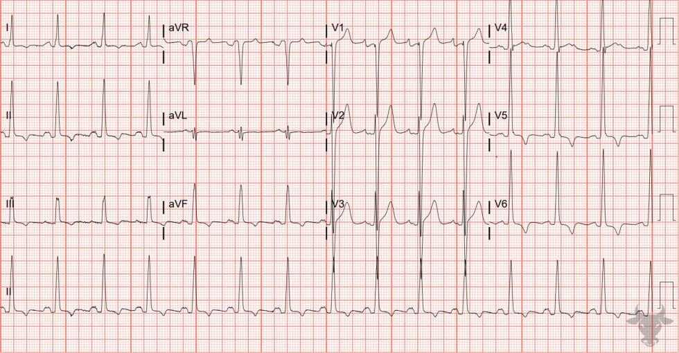 Left Atrial Enlargement | ECG Stampede