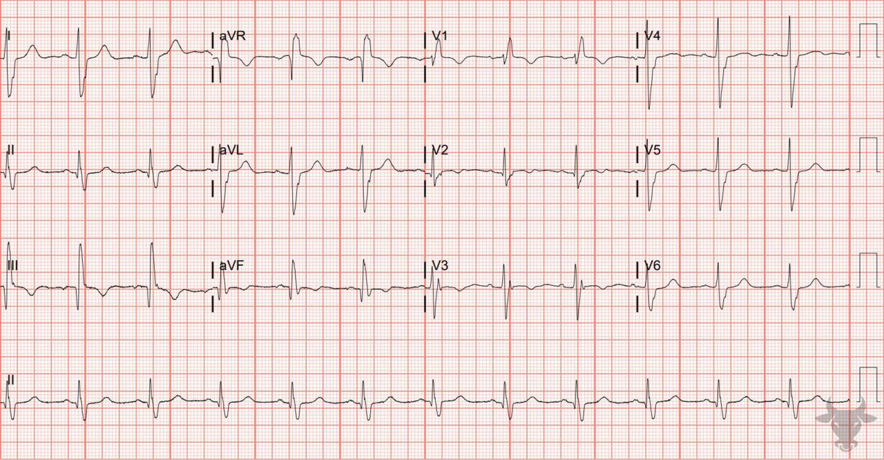 Left Posterior Fascicular Block | ECG Stampede