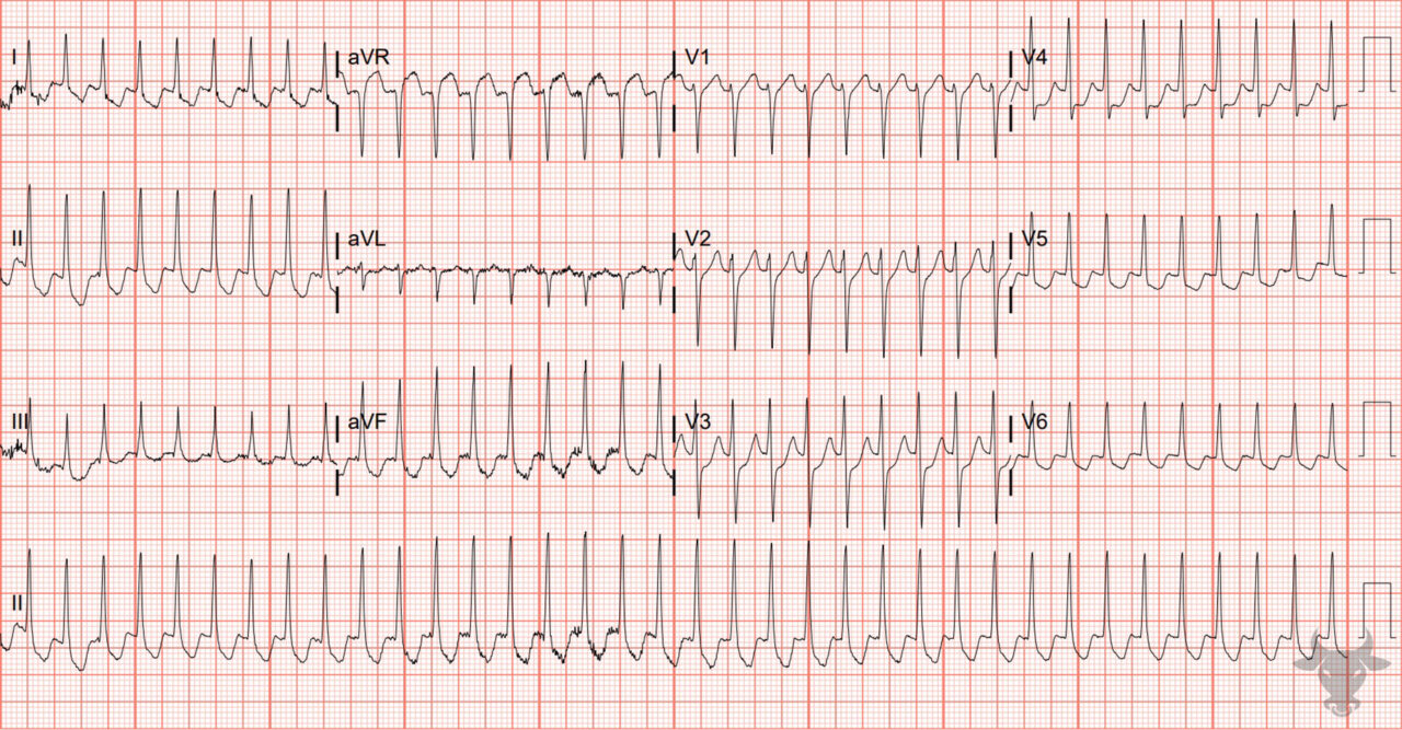 Ventricular Pre-excitation | ECG Stampede