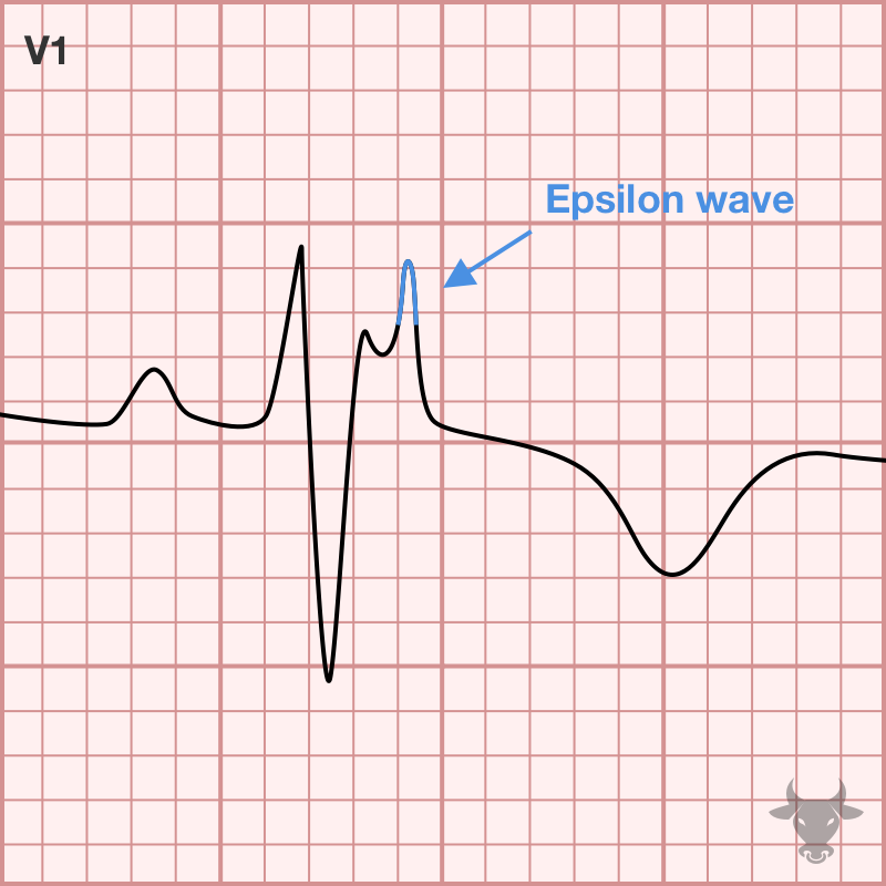 Arrhythmogenic Right Ventricular Cardiomyopathy