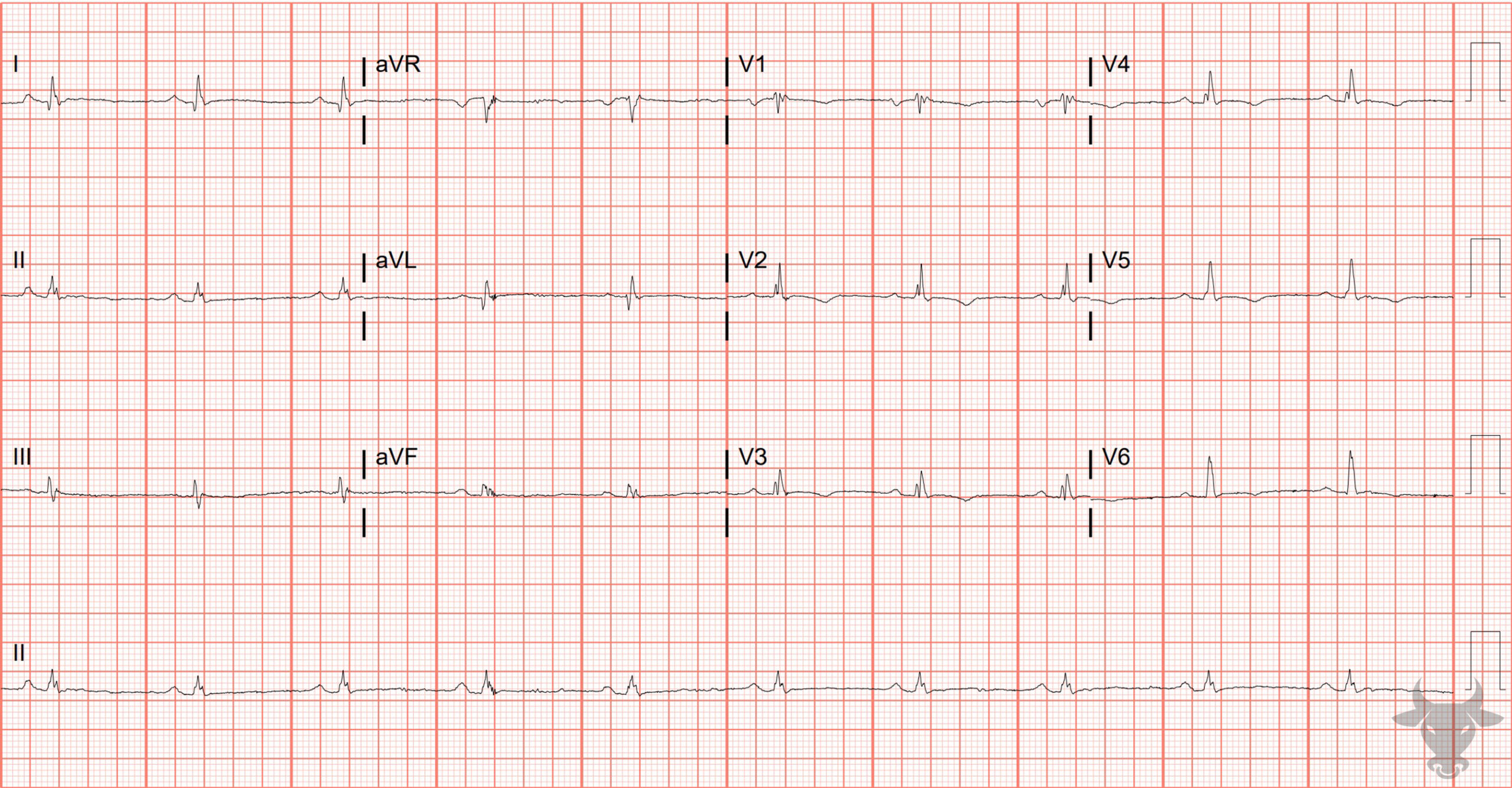 ECG Showing Arrhythmogenic Right Ventricular Cardiomyopathy