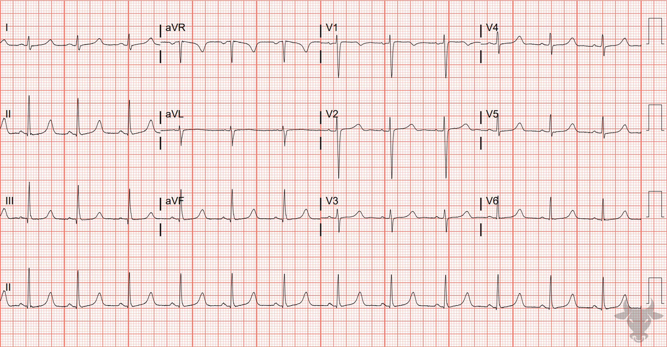 ECG Showing Hypocalcemia