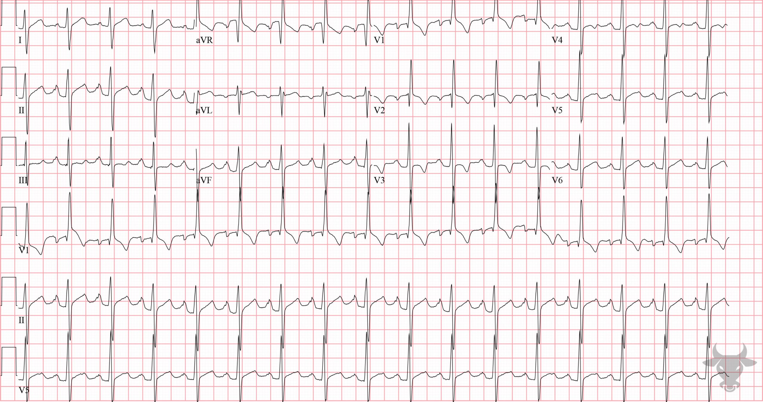 ECG Showing Right Ventricular Hypertrophy