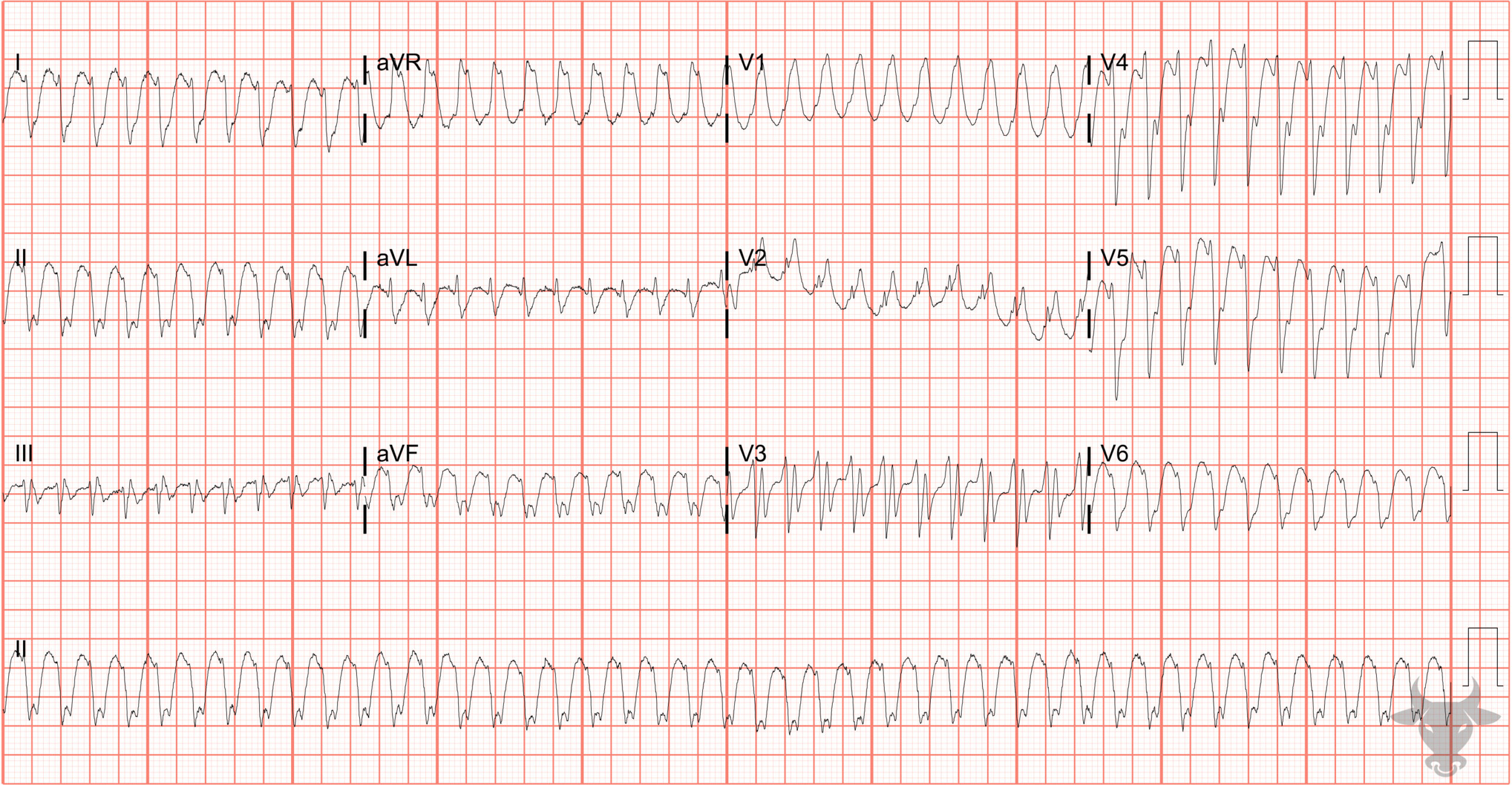 ECG Showing Atrial Flutter With 1:1 Conduction