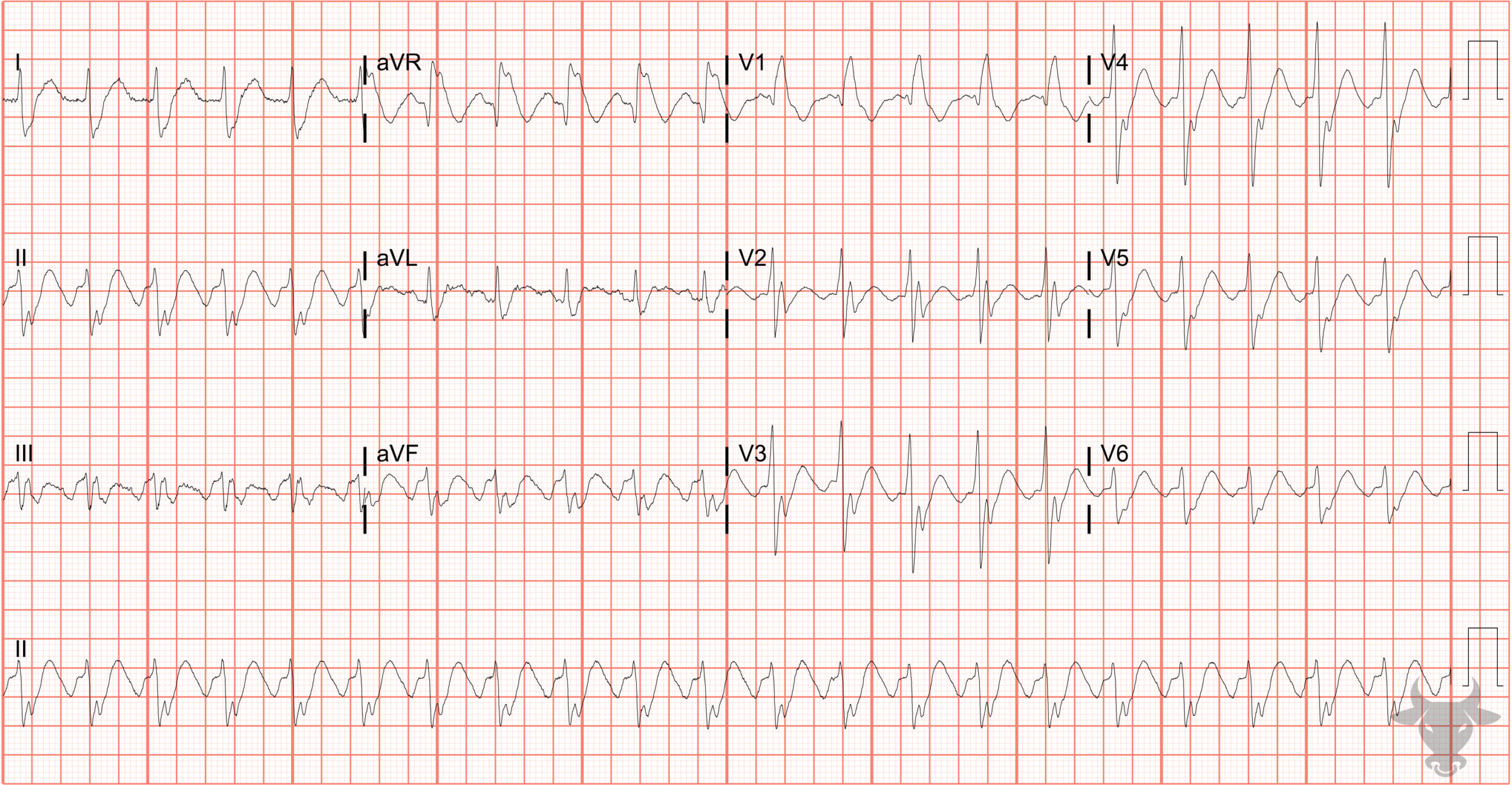 ECG Showing Atrial Flutter With 2:1 Conduction