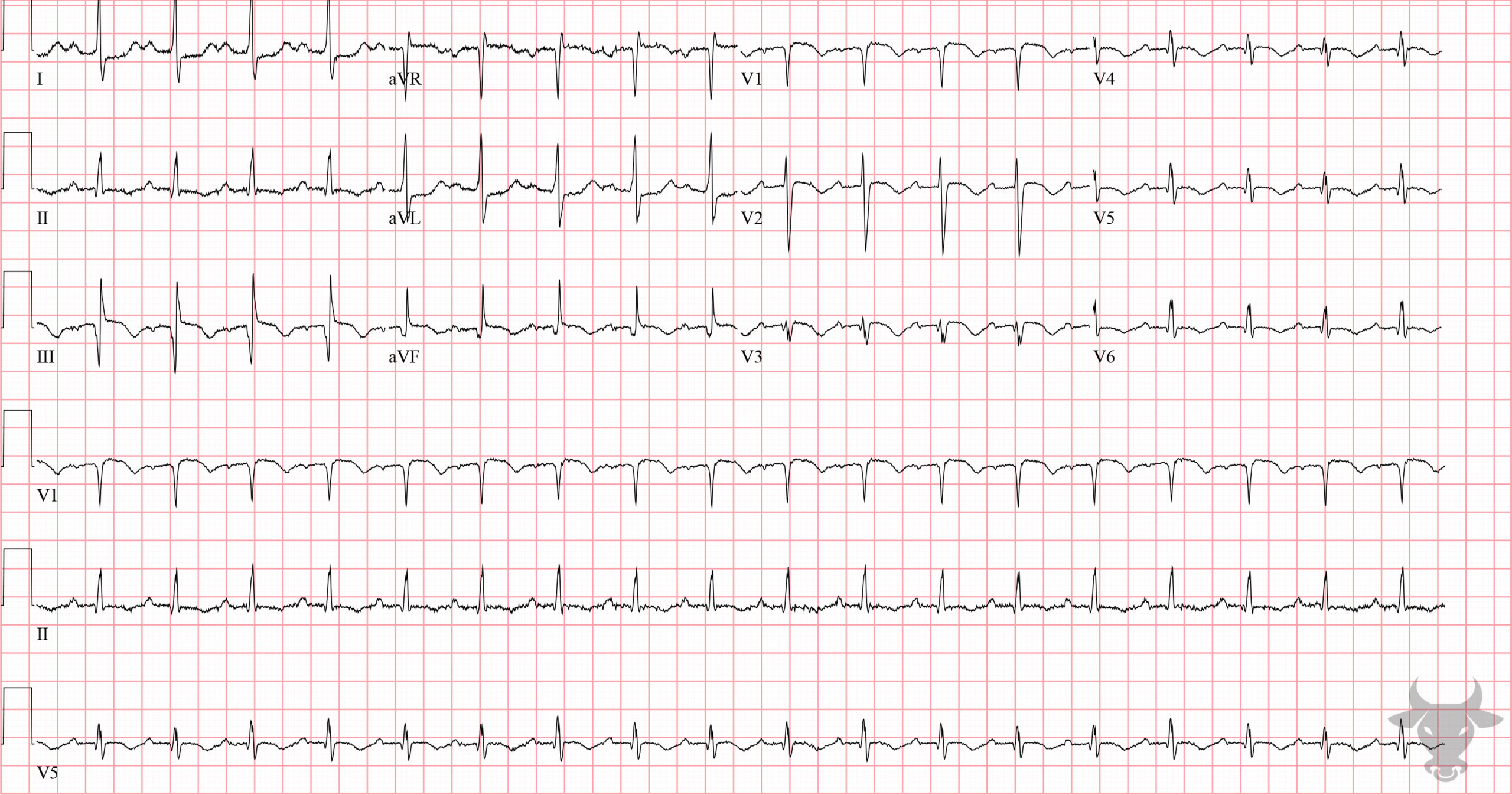 ECG Showing Pulmonary Embolism