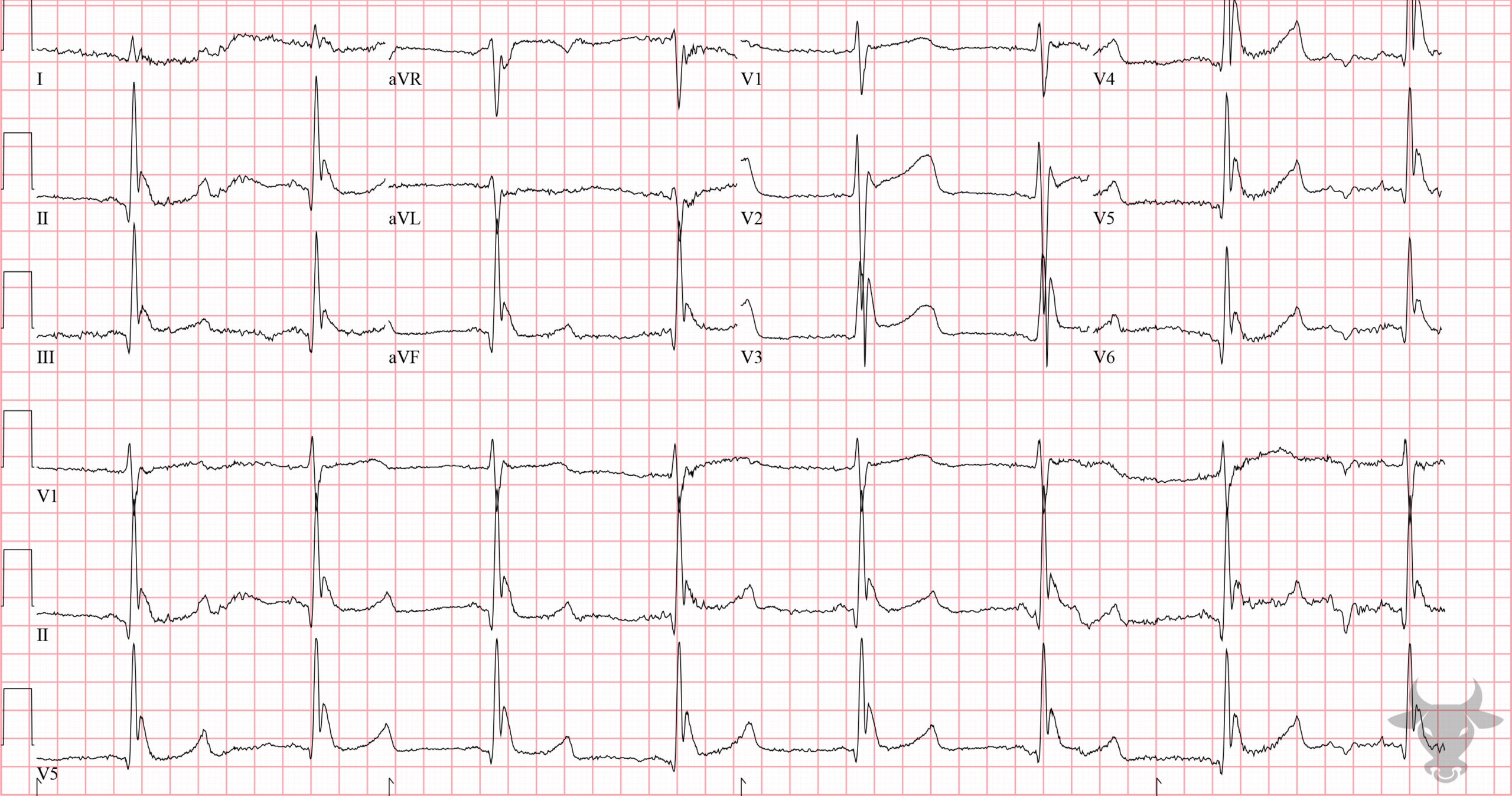 ECG Showing Hypothermia